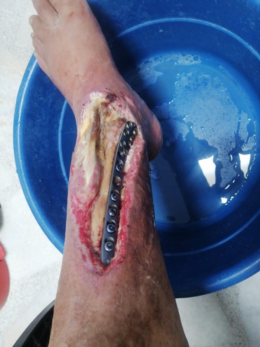 herida en pie izquierdo. 